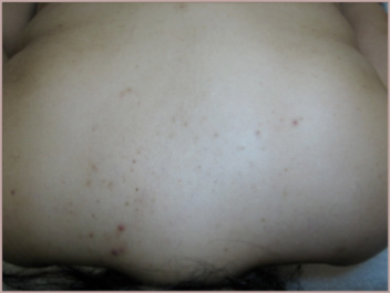 inflamed body acne photo