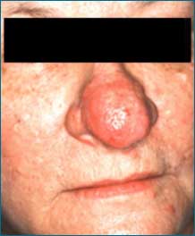 What Is Rosacea?