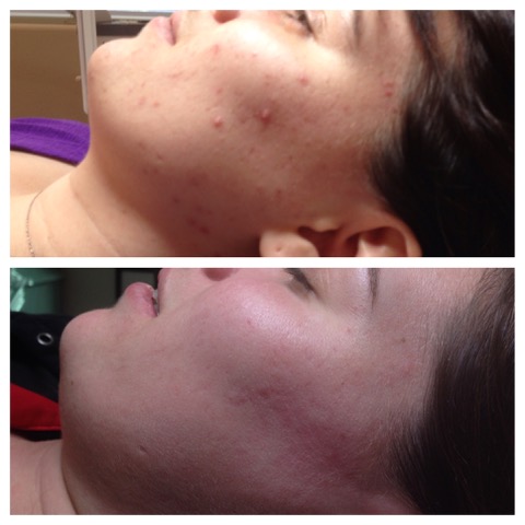 Tachi Skin Care Services Before and After - Success with acne treatments