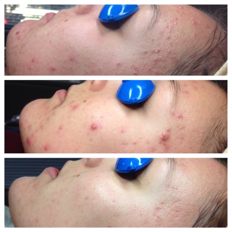 Tachi Skin Care Services Before and After - Success with acne treatments